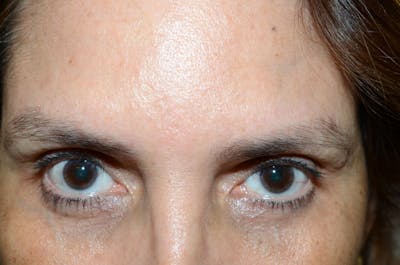 Eyebrow Transplantation Before & After Gallery - Patient 427613 - Image 1