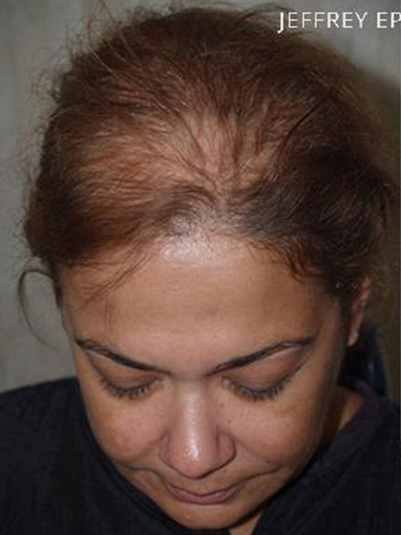 Hair Procedures for Women Before & After Gallery - Patient 108434 - Image 1
