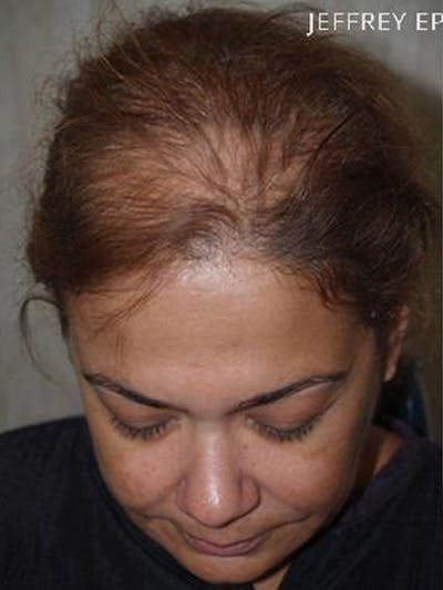 Hair Procedures for Women Before & After Gallery - Patient 208990 - Image 1
