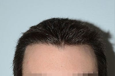 Hair Restoration for Men Before & After Gallery - Patient 252099 - Image 2