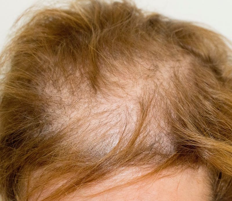 Scalp Micropigmentation Procedures Before & After Gallery - Patient 117092 - Image 1