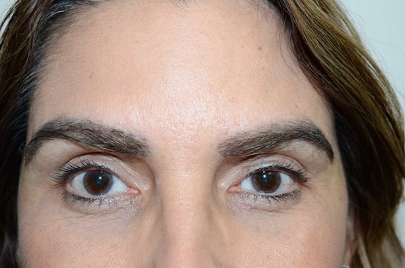 Eyebrow Transplantation Before & After Gallery - Patient 334968 - Image 2