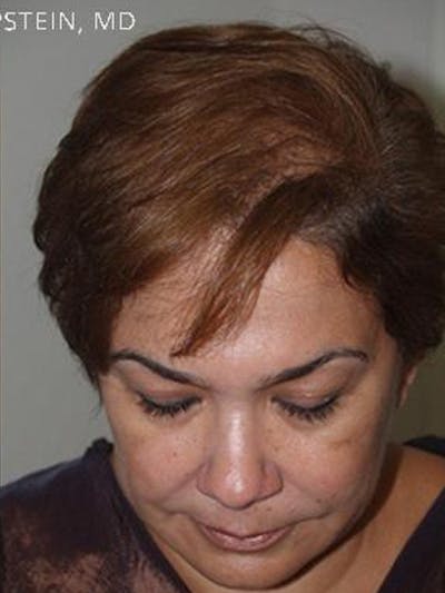 Hair Procedures for Women Before & After Gallery - Patient 208990 - Image 2