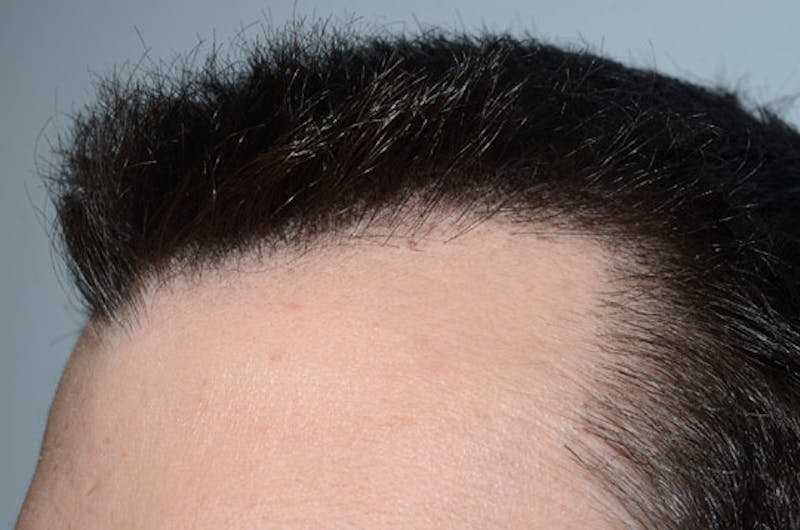 Hair Restoration for Men Before & After Gallery - Patient 239786 - Image 4