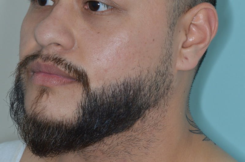 Facial Hair Transplant Before & After Gallery - Patient 241085 - Image 4