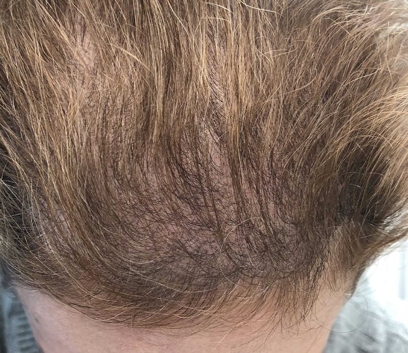 Scalp Micropigmentation Procedures Before & After Gallery - Patient 117092 - Image 2