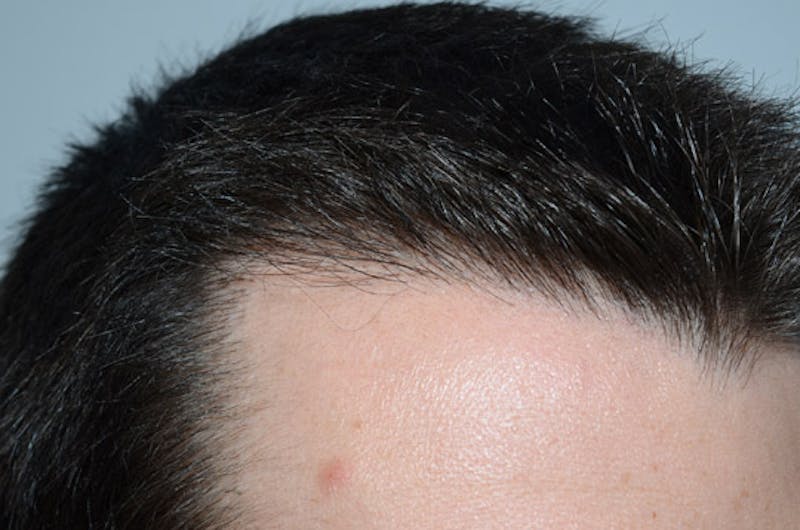 Hair Restoration for Men Before & After Gallery - Patient 239786 - Image 6