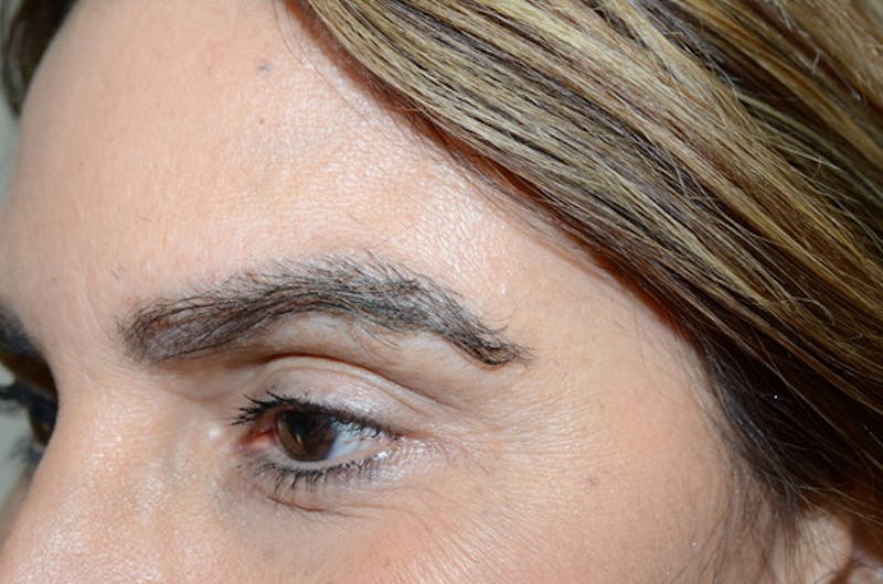 Eyebrow Transplantation Before & After Gallery - Patient 334968 - Image 4