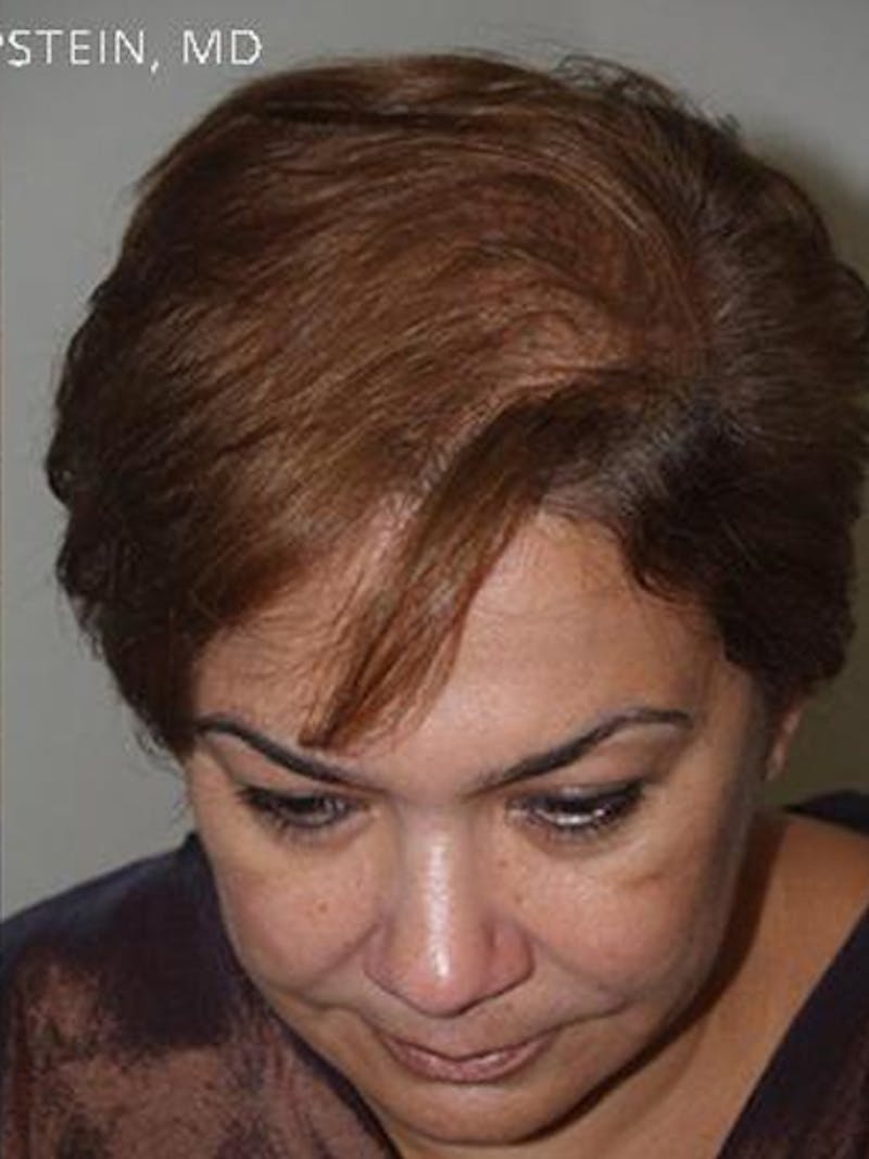 Hair Procedures for Women Before & After Gallery - Patient 108434 - Image 4