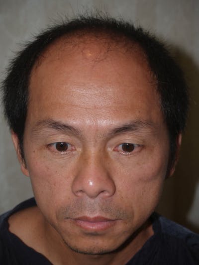 Hair Restoration for Men Before & After Gallery - Patient 249898 - Image 1