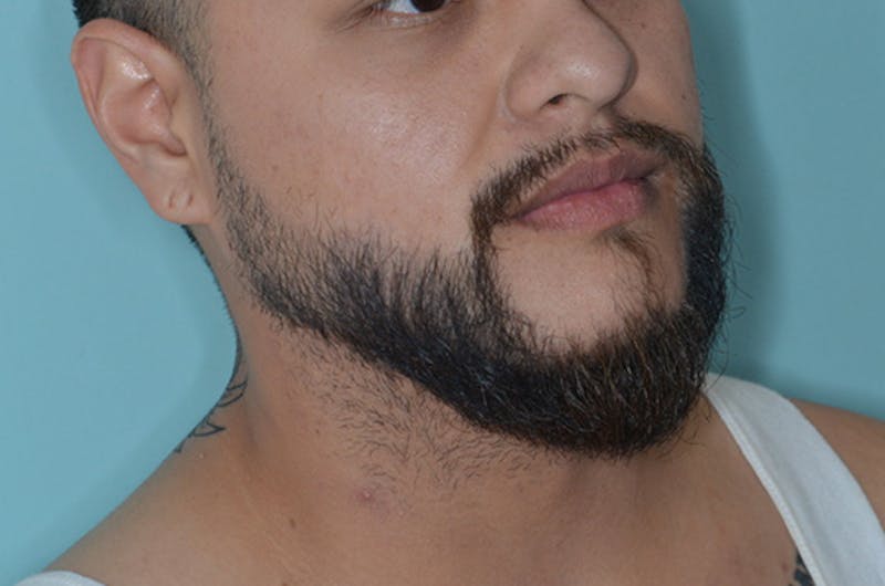 Facial Hair Transplant Before & After Gallery - Patient 241085 - Image 6