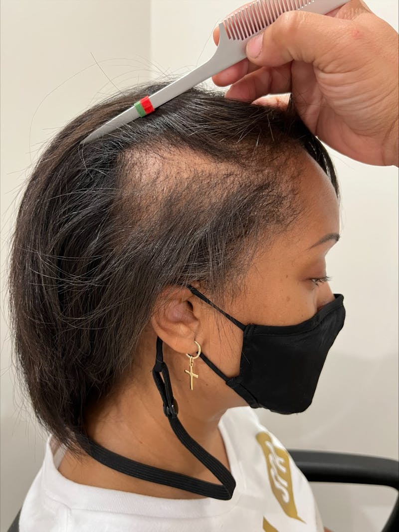 Scalp Micropigmentation Procedures Before & After Gallery - Patient 405058 - Image 1