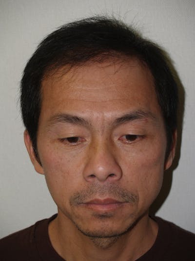 Hair Restoration for Men Before & After Gallery - Patient 249898 - Image 2