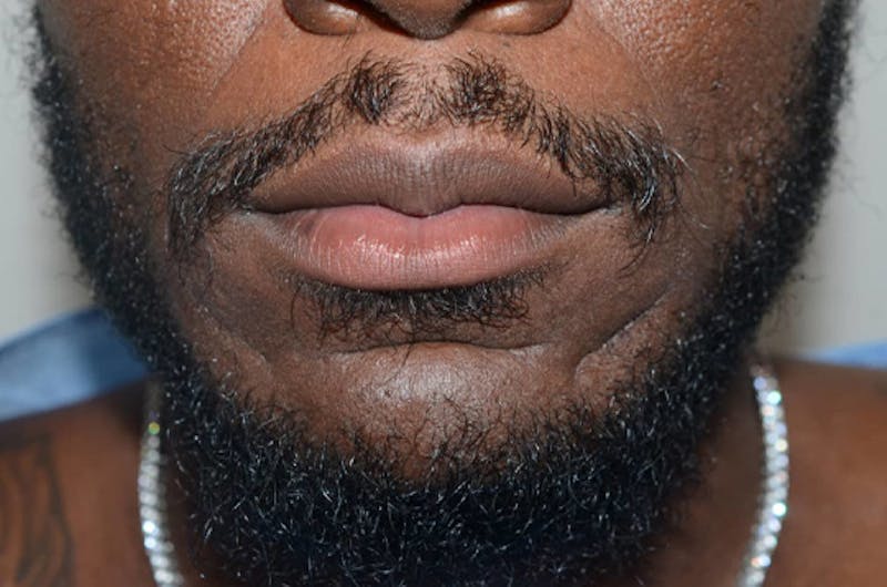 Facial Hair Transplant Before & After Gallery - Patient 145683 - Image 1