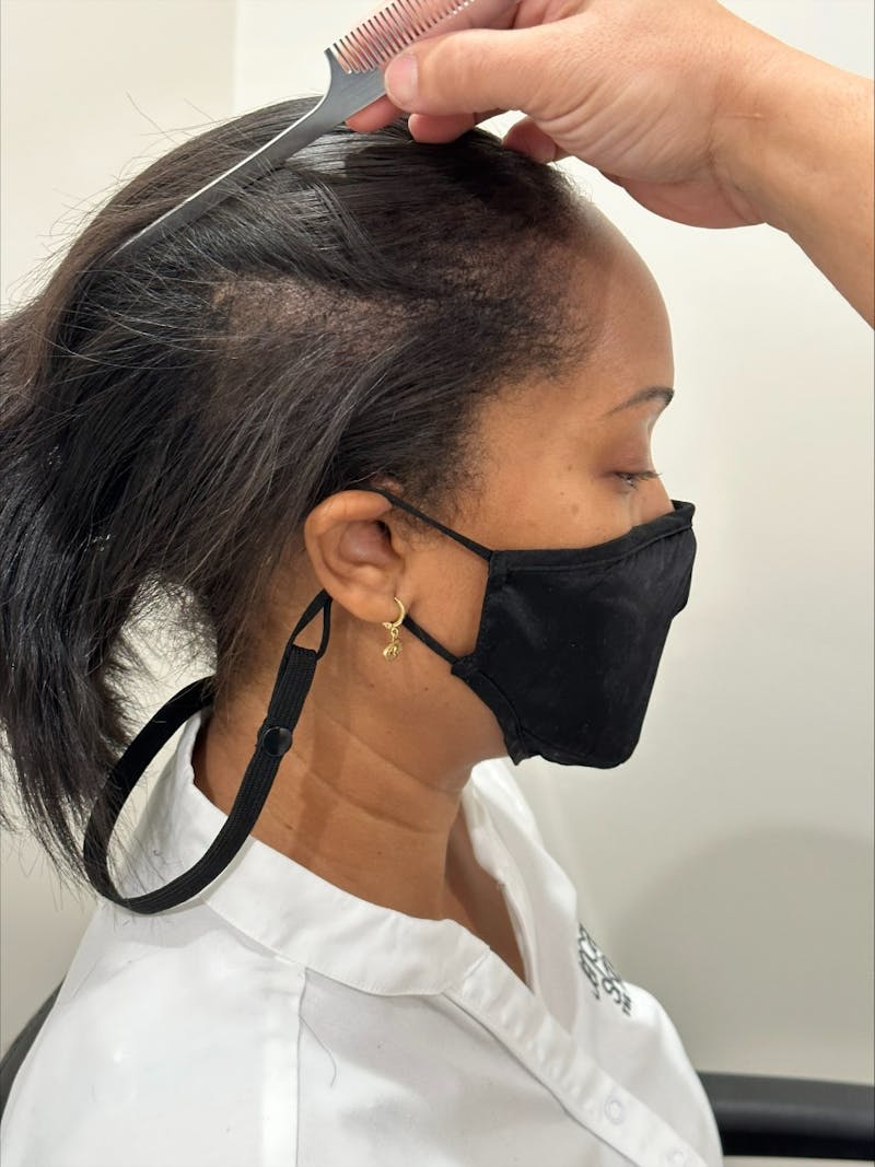 Scalp Micropigmentation Procedures Before & After Gallery - Patient 405058 - Image 2