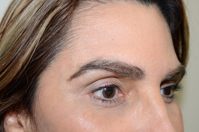 Eyebrow Transplantation Before & After Gallery - Patient 334968 - Image 6