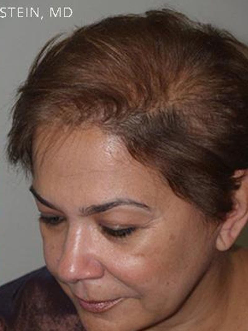 Hair Procedures for Women Before & After Gallery - Patient 108434 - Image 6