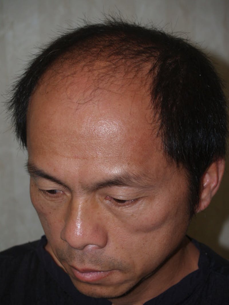 Hair Restoration for Men Before & After Gallery - Patient 597974 - Image 3