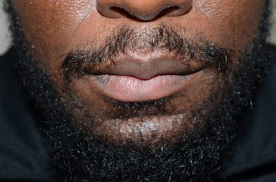 Facial Hair Transplant Before & After Gallery - Patient 291231 - Image 2
