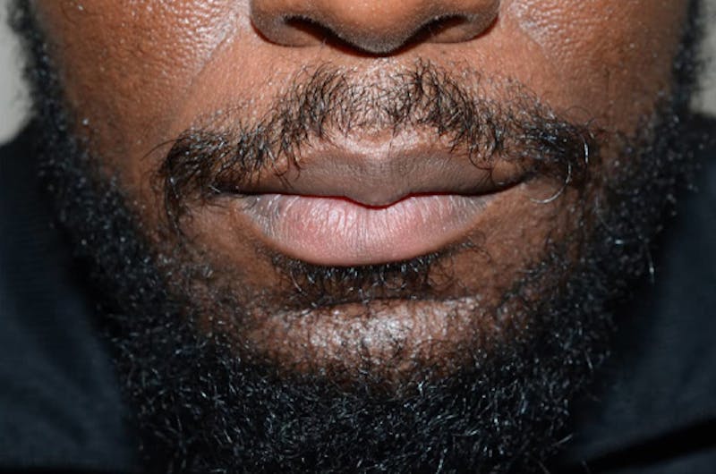 Facial Hair Transplant Before & After Gallery - Patient 145683 - Image 2