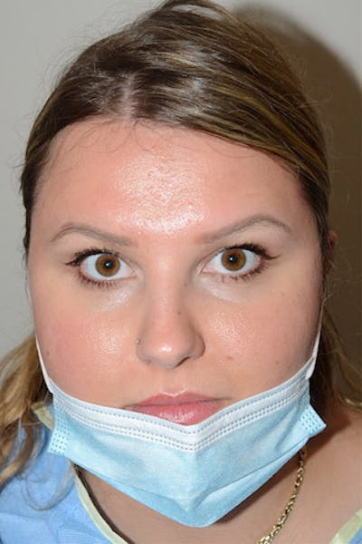 Eyebrow Transplantation Before & After Gallery - Patient 251494 - Image 1