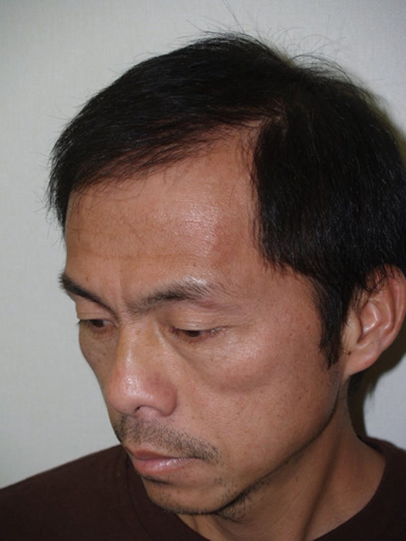 Hair Restoration for Men Before & After Gallery - Patient 597974 - Image 4