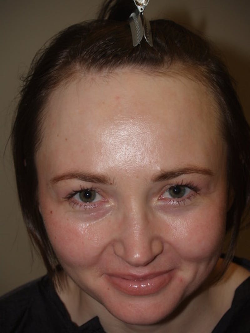 Hair Procedures for Women Before & After Gallery - Patient 327711 - Image 1