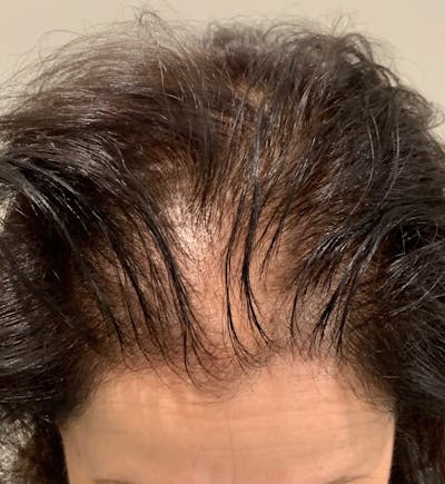 SMP Procedures Before & After Gallery - Patient 426793 - Image 1