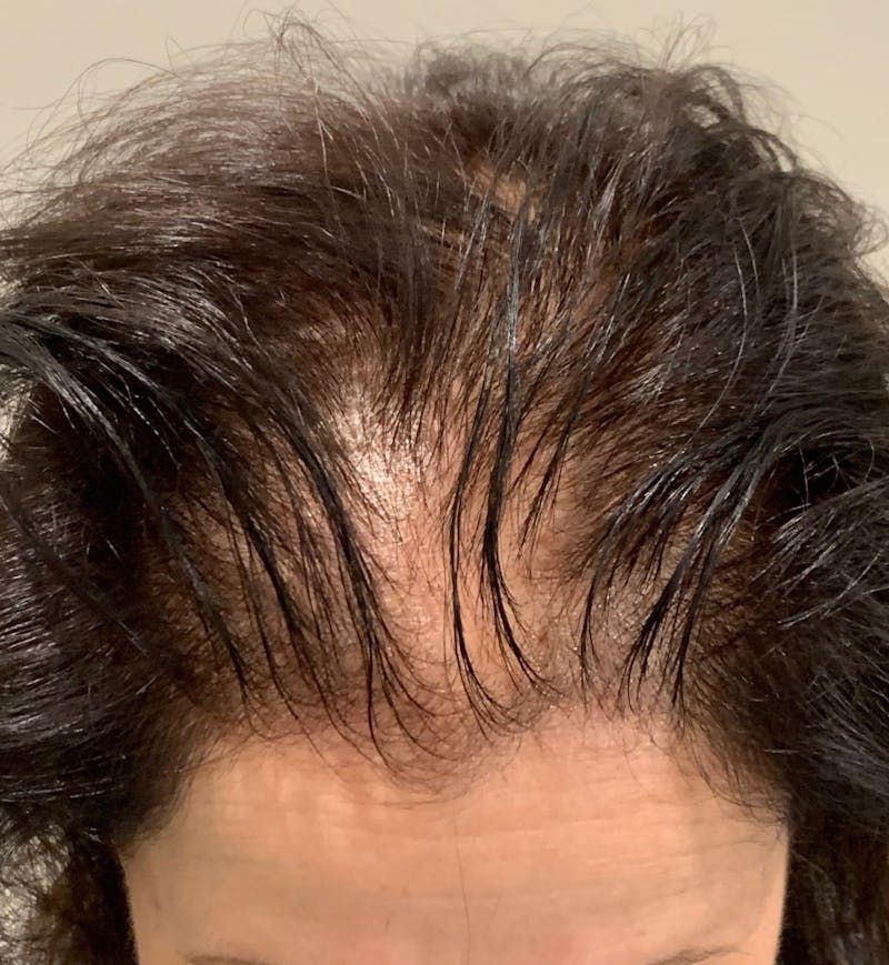 Scalp Micropigmentation Procedures Before & After Gallery - Patient 406437 - Image 1