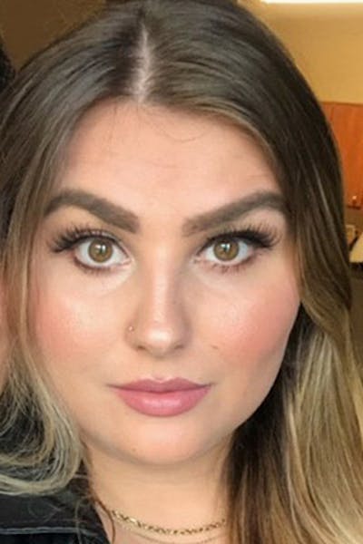 Eyebrow Transplantation Before & After Gallery - Patient 251494 - Image 2