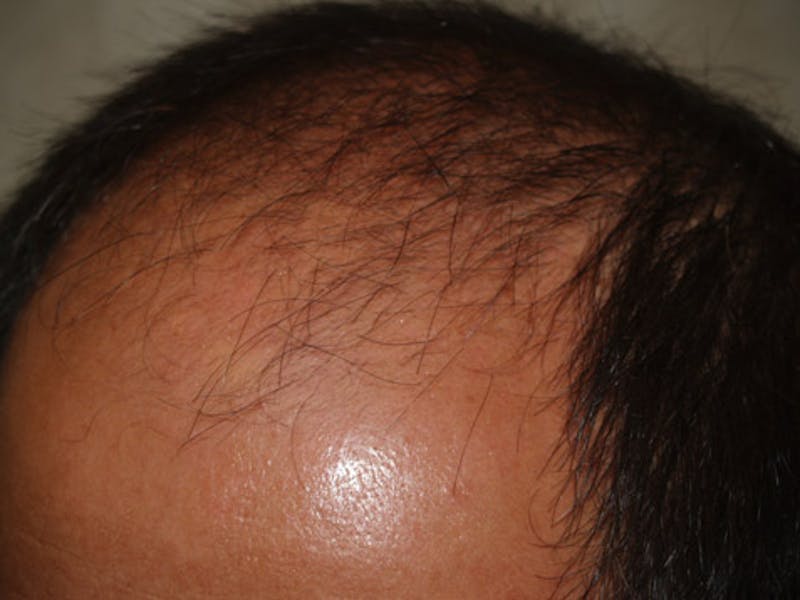 Hair Restoration for Men Before & After Gallery - Patient 597974 - Image 5
