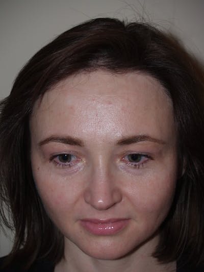 Hair Procedures for Women Before & After Gallery - Patient 352124 - Image 2