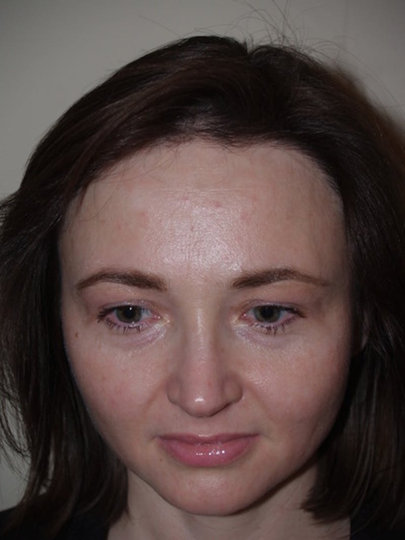Hair Procedures for Women Before & After Gallery - Patient 327711 - Image 2
