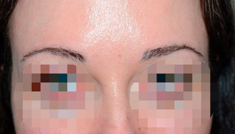 Eyebrow Transplantation Before & After Gallery - Patient 429093 - Image 1