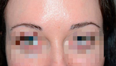 Eyebrow Transplantation Before & After Gallery - Patient 256021 - Image 1