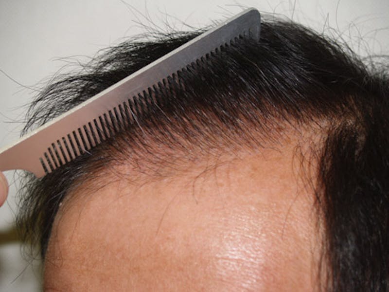 Hair Restoration for Men Before & After Gallery - Patient 597974 - Image 6