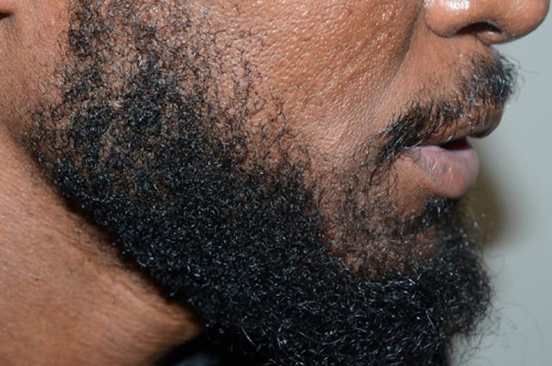 Facial Hair Transplant Before & After Gallery - Patient 145683 - Image 4