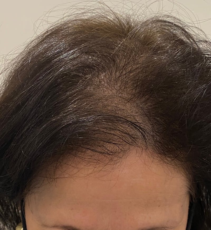 Scalp Micropigmentation Procedures Before & After Gallery - Patient 406437 - Image 2