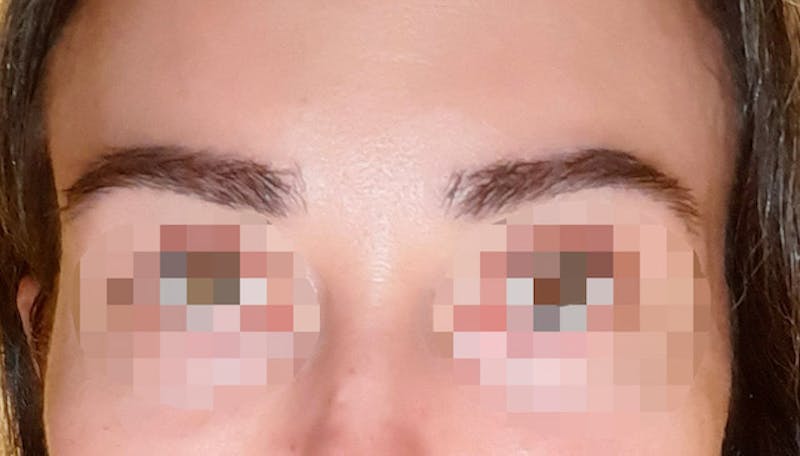 Eyebrow Transplantation Before & After Gallery - Patient 429093 - Image 2