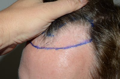 Hair Restoration for Men Before & After Gallery - Patient 398851 - Image 1