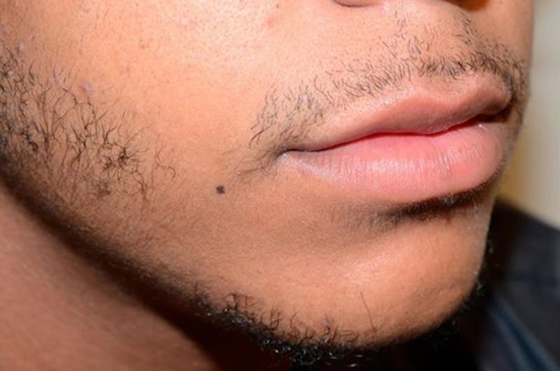 Facial Hair Transplant Before & After Gallery - Patient 185653 - Image 1