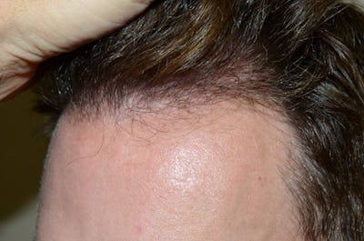 Hair Restoration for Men Before & After Gallery - Patient 398851 - Image 2