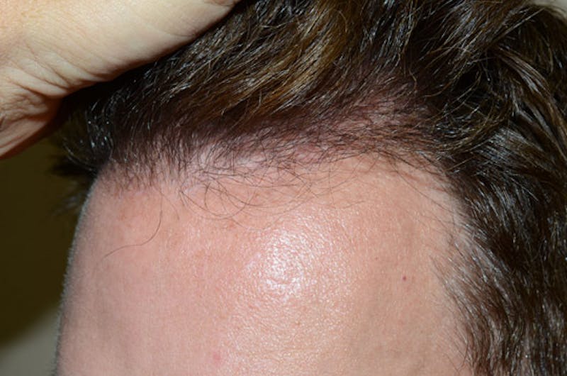 Hair Restoration for Men Before & After Gallery - Patient 647630 - Image 2