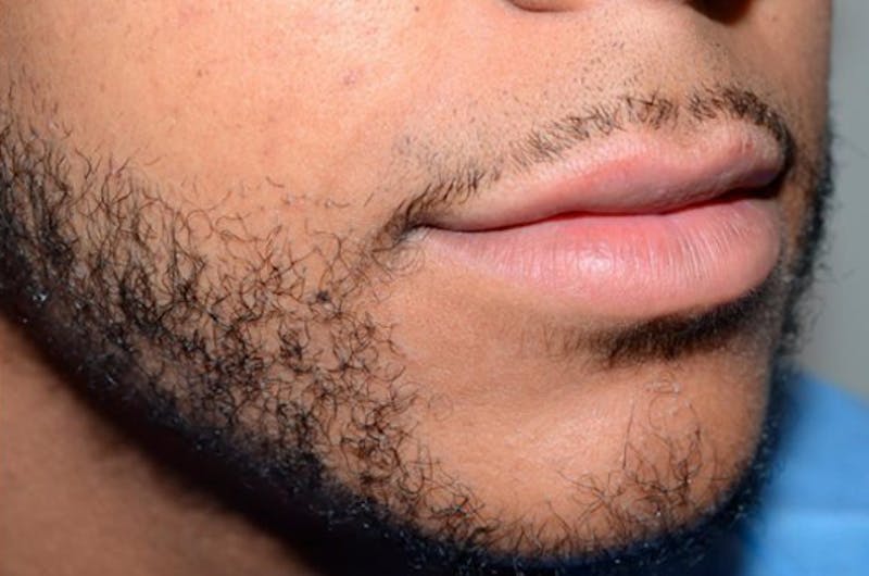 Facial Hair Transplant Before & After Gallery - Patient 185653 - Image 2