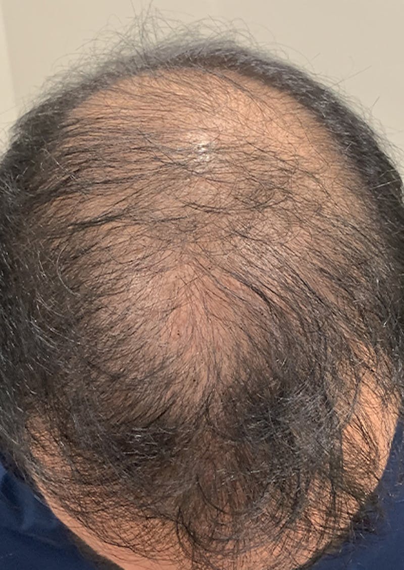Scalp Micropigmentation Procedures Before & After Gallery - Patient 409522 - Image 1