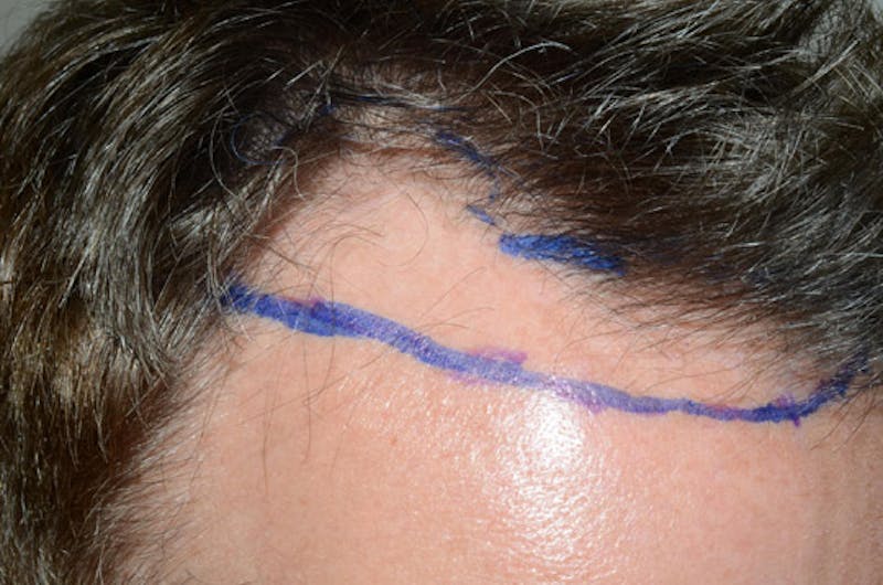 Hair Restoration for Men Before & After Gallery - Patient 647630 - Image 3