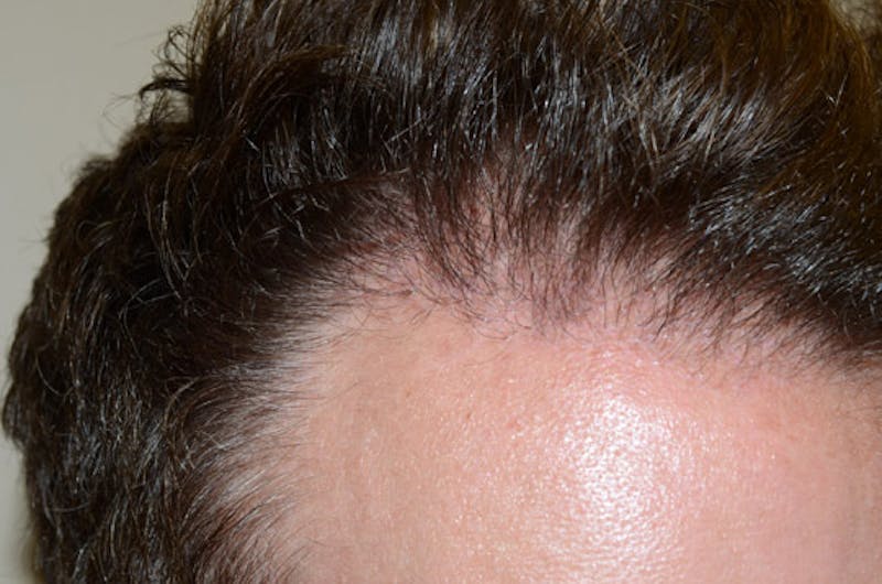 Hair Restoration for Men Before & After Gallery - Patient 647630 - Image 4