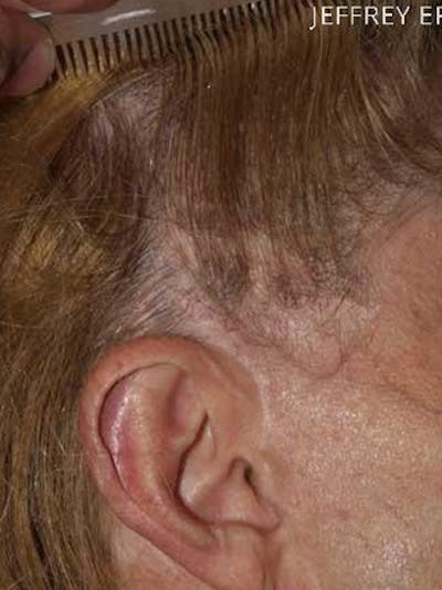 Hair Procedures for Women Before & After Gallery - Patient 225189 - Image 1