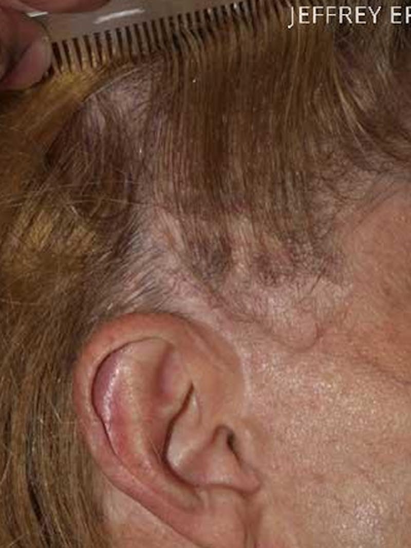 Facial Hair Transplant Before & After Gallery - Patient 344806 - Image 1
