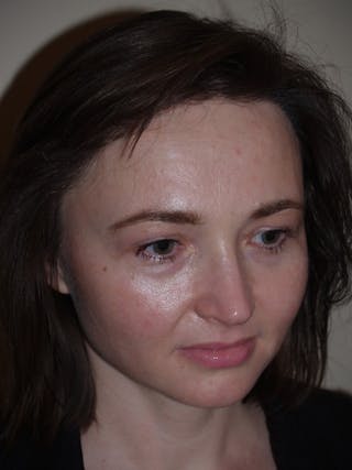 Hair Procedures for Women Before & After Gallery - Patient 327711 - Image 6